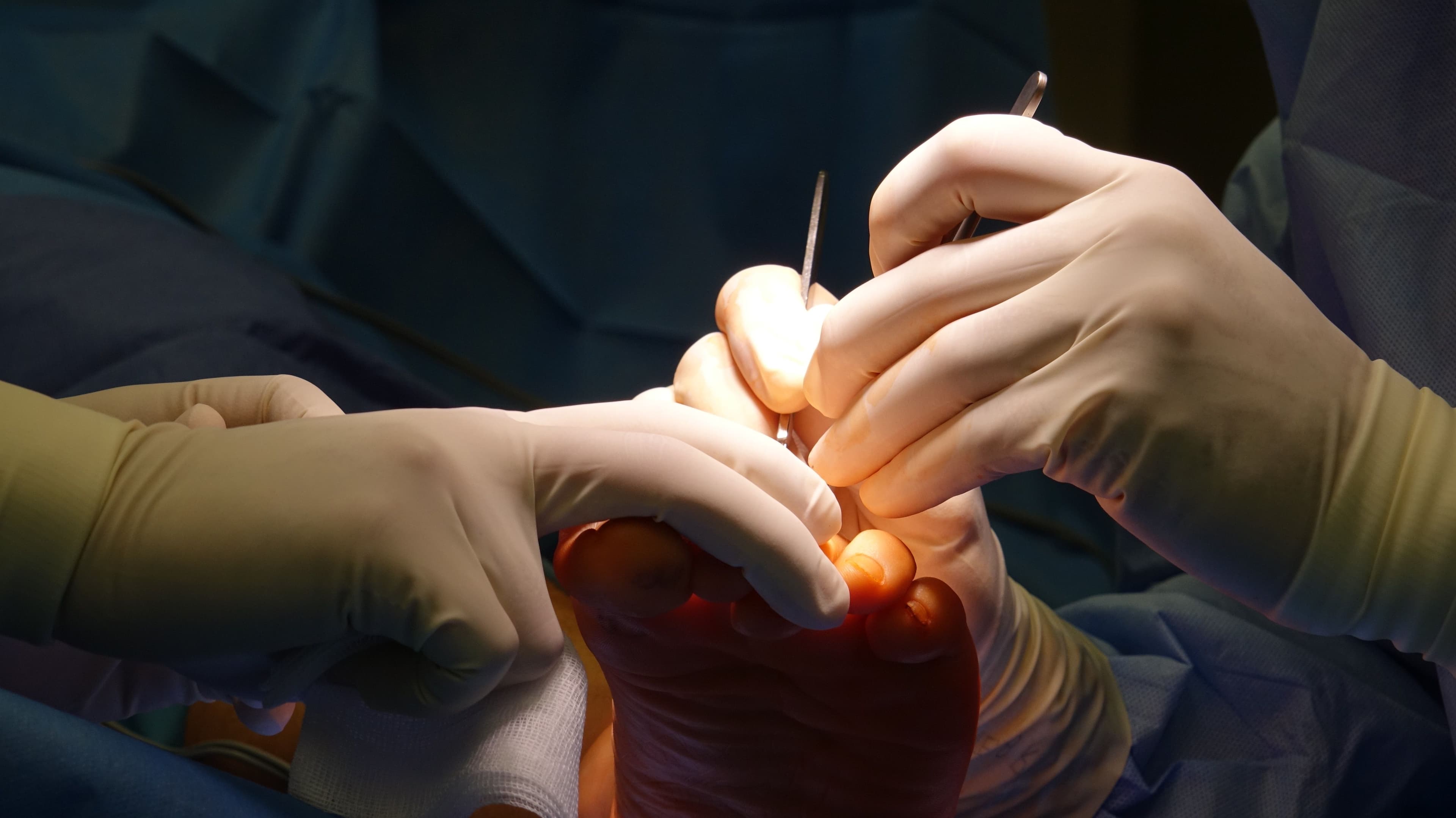 What is a Ganglion? - Featured image for FALL Clinic Perth podiatry article