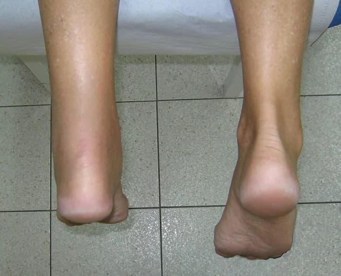 Achilles Tendon Injuries - Podiatry health article from FALL Clinic Perth