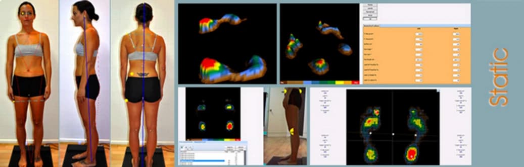 What Is a Gait and Pressure Analysis Treadmill? - Podiatry health article from FALL Clinic Perth