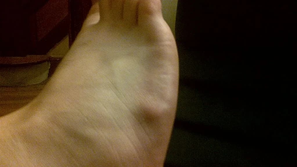 What is a Ganglion? - Podiatry health article from FALL Clinic Perth