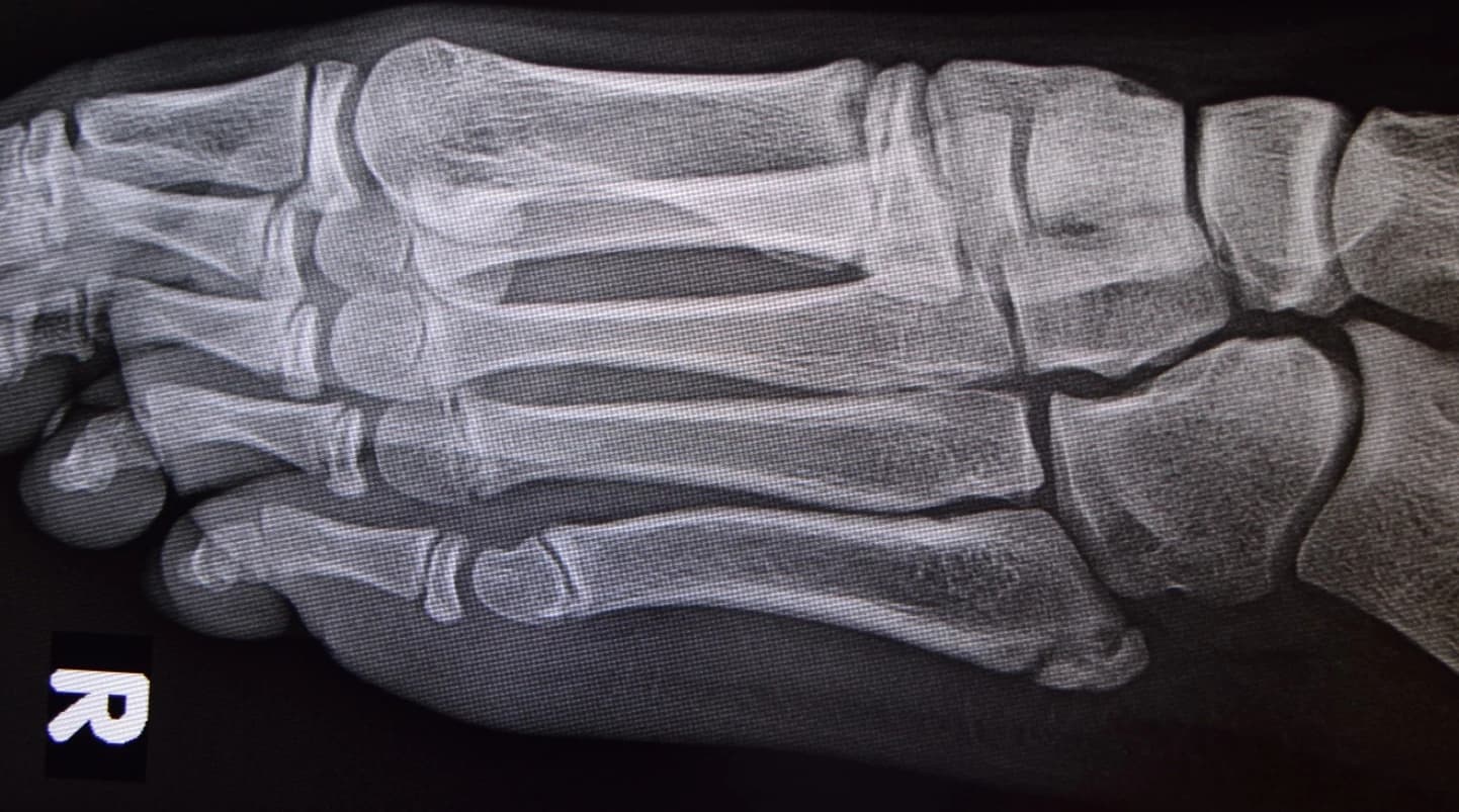 Why is my child getting pain on the outside of their foot (Iselin's Disease)? - Podiatry health article from FALL Clinic Perth