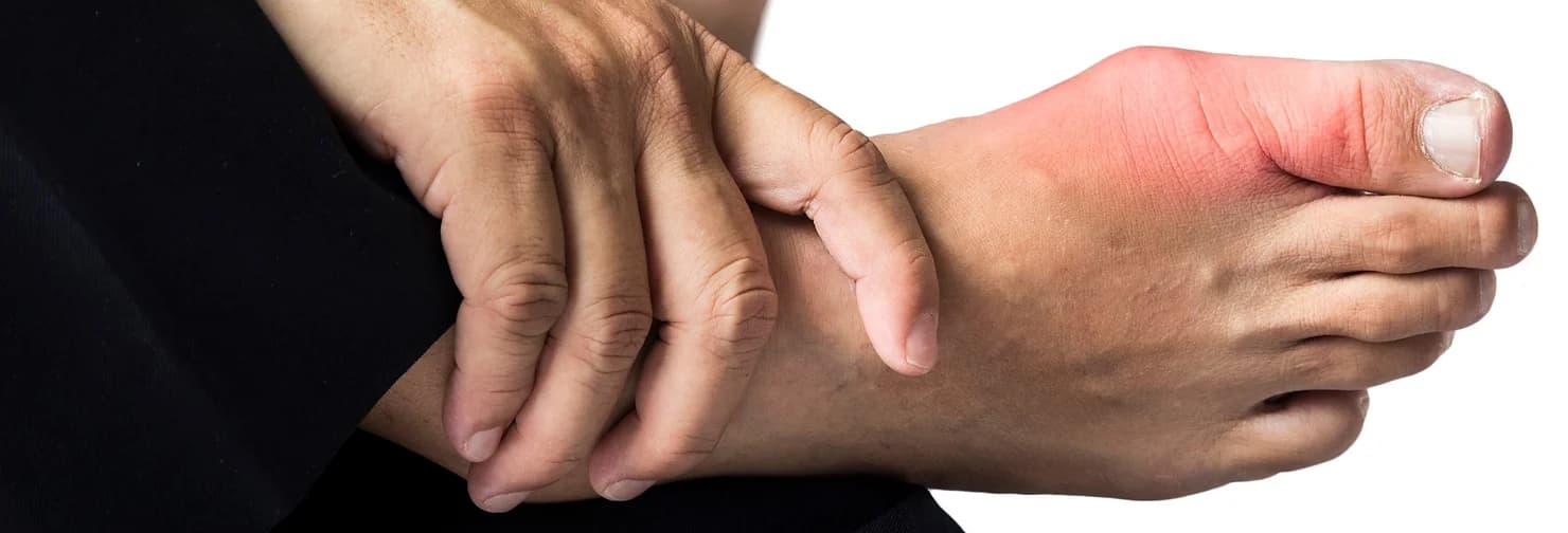 Gout (or Podagra) - Podiatry health article from FALL Clinic Perth