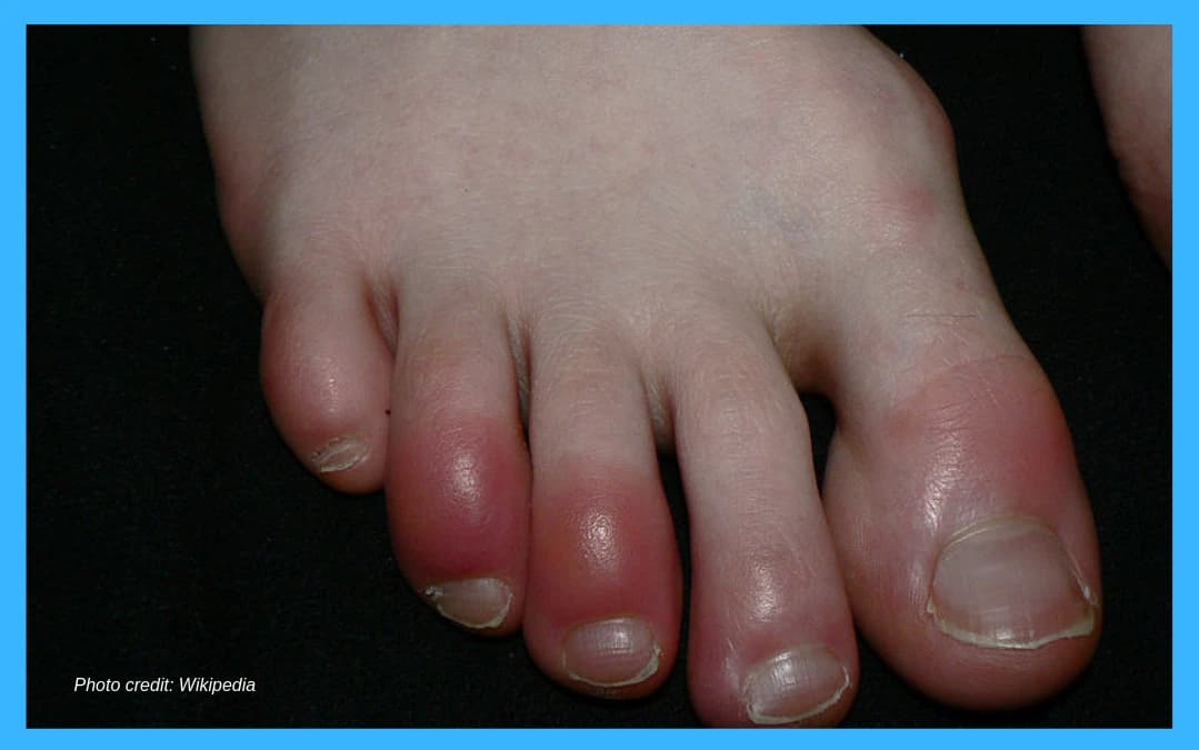 Chilblains - Podiatry health article from FALL Clinic Perth