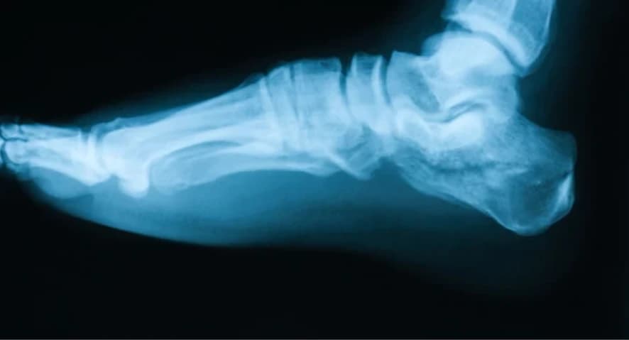 Sesamoiditis - Podiatry health article from FALL Clinic Perth