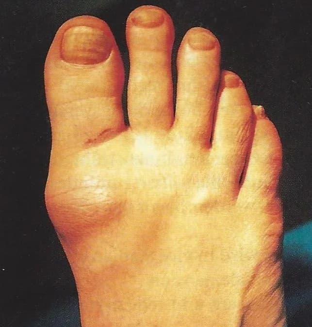 Stiff Big Toe (Hallux Rigidus) - Podiatry health article from FALL Clinic Perth
