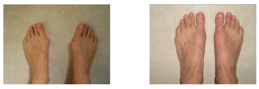 Bunion Surgery: Pre and Post Op - Podiatry health article from FALL Clinic Perth