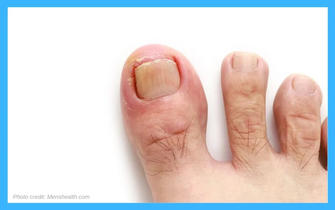 Ingrown Toenail Surgery Benefits - Podiatry health article from FALL Clinic Perth