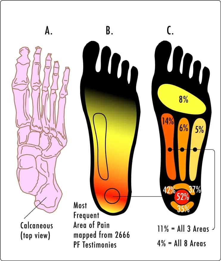 Plantar Fasciitis Case History - Podiatry health article from FALL Clinic Perth