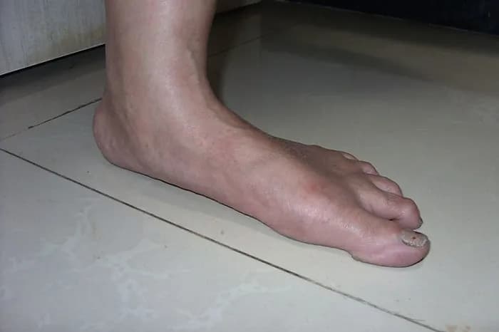 Flat Feet - Podiatry health article from FALL Clinic Perth