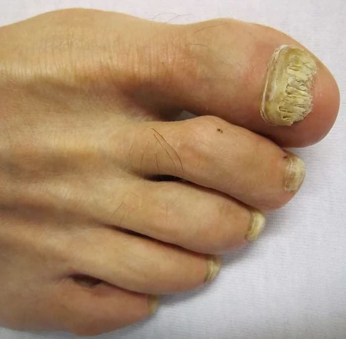 Fungal Nails - Podiatry health article from FALL Clinic Perth