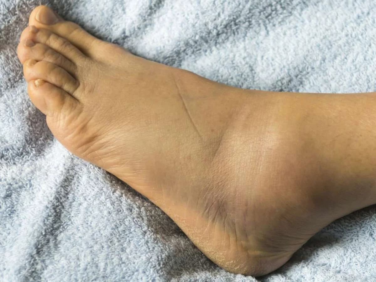 Why Do I Get Swollen Feet and Ankles? - Podiatry health article from FALL Clinic Perth