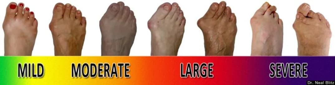 Bunions - Podiatry health article from FALL Clinic Perth