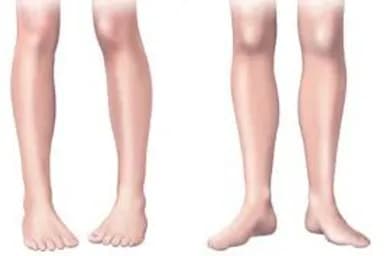In Toed Gait - Podiatry health article from FALL Clinic Perth