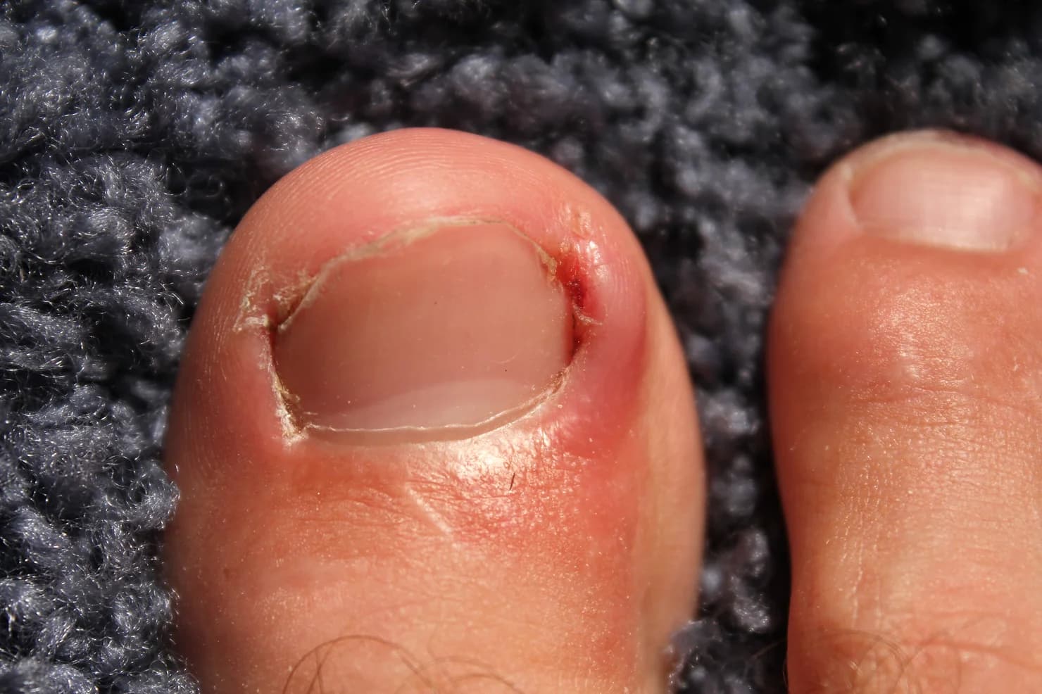 7 Myths of Ingrown Toenails - Podiatry health article from FALL Clinic Perth