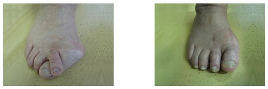 Hammertoe & Bunion Surgery: Before and After - Podiatry health article from FALL Clinic Perth