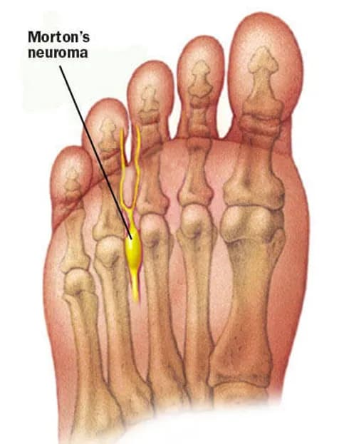 Morton’s Neuroma - Podiatry health article from FALL Clinic Perth