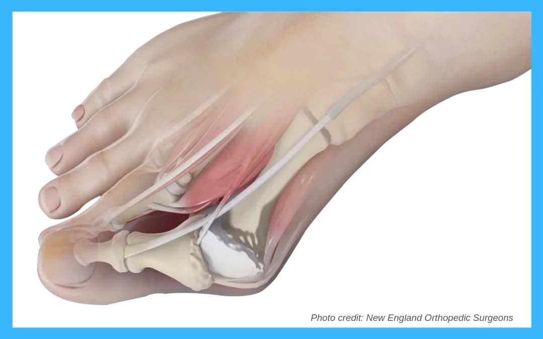 Bunion Removal: Before and After - Podiatry health article from FALL Clinic Perth