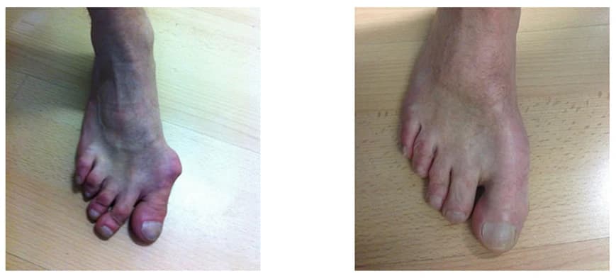 Forefoot Reconstruction Surgery: Before and After Photos - Podiatry health article from FALL Clinic Perth