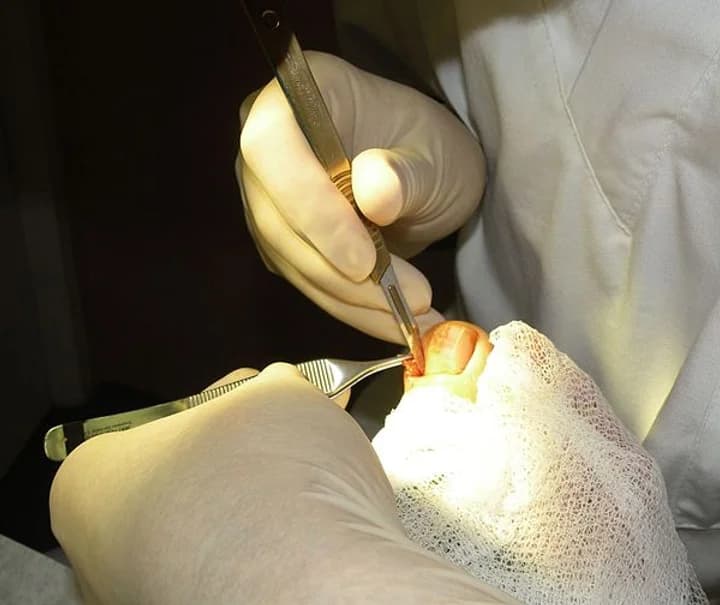 Ingrown Toe Nail Treatment: 7 Reasons Why You Should Come To Us - Podiatry health article from FALL Clinic Perth
