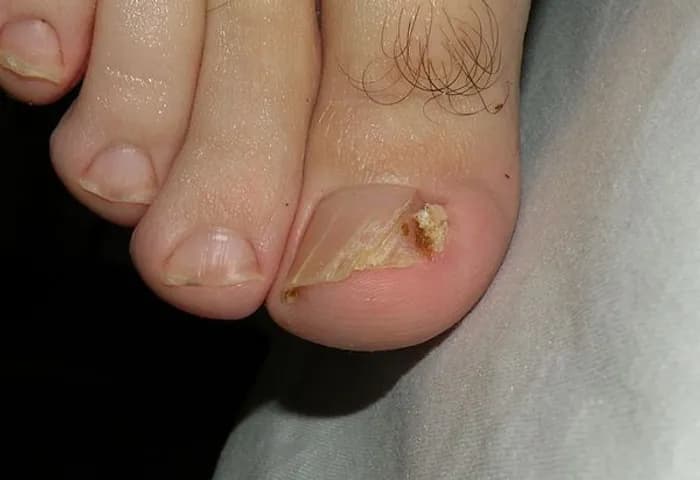 Ingrown Toenails - Podiatry health article from FALL Clinic Perth