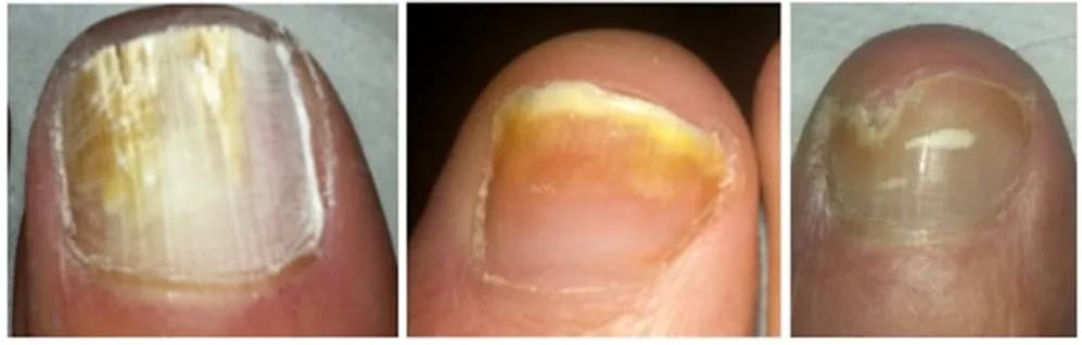 Fungal Nail Infections - Podiatry health article from FALL Clinic Perth