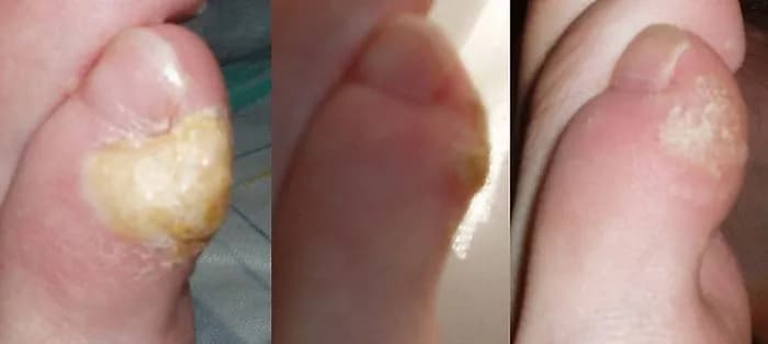 Corns and Calluses - Podiatry health article from FALL Clinic Perth