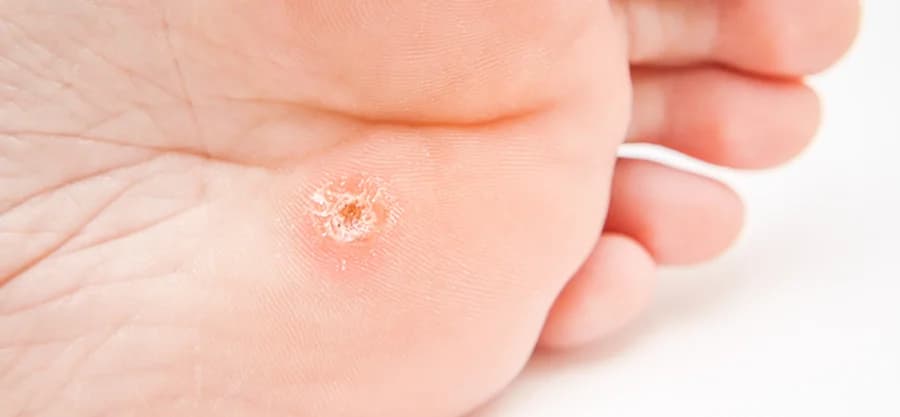 Wart is this on my foot? – Verruca Pedis - Podiatry health article from FALL Clinic Perth