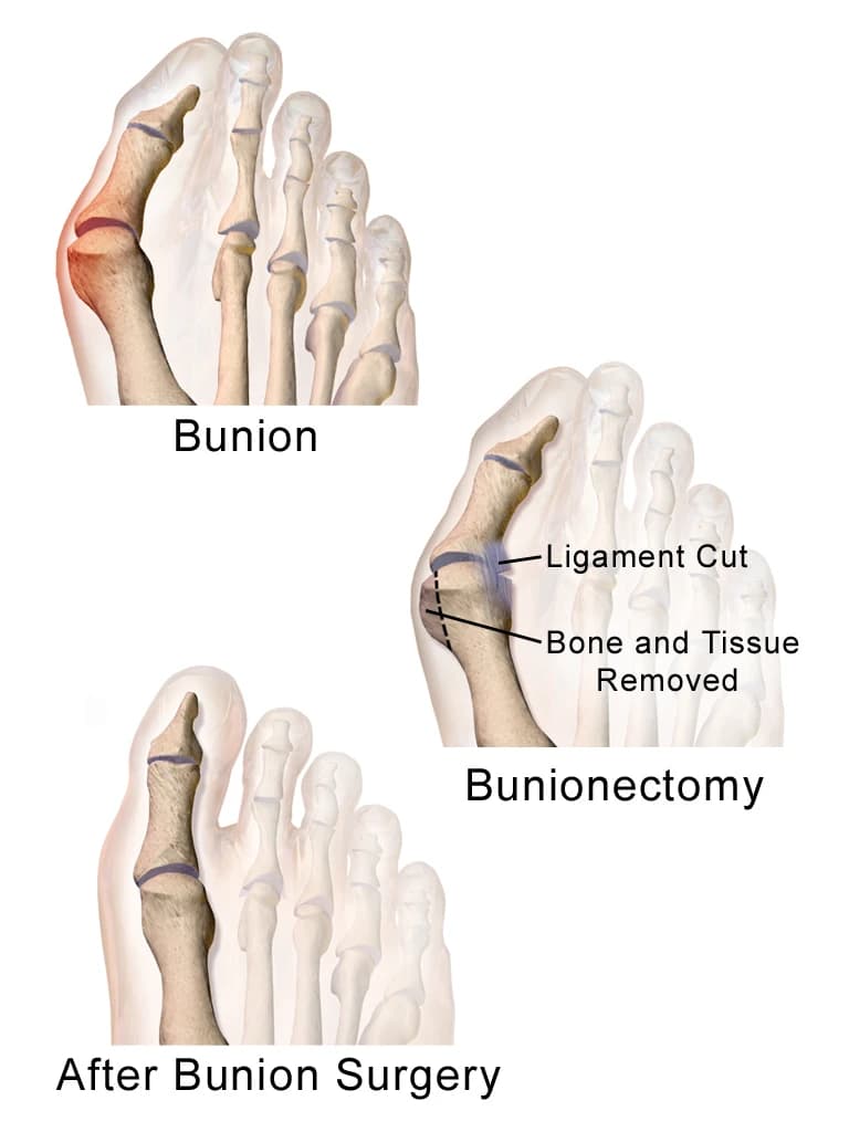 Bunion Surgery - Podiatry health article from FALL Clinic Perth