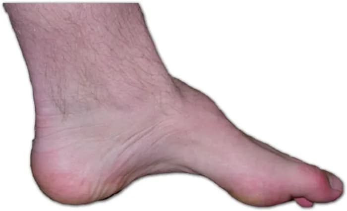 High Arch Foot (Pes Cavus) - Podiatry health article from FALL Clinic Perth
