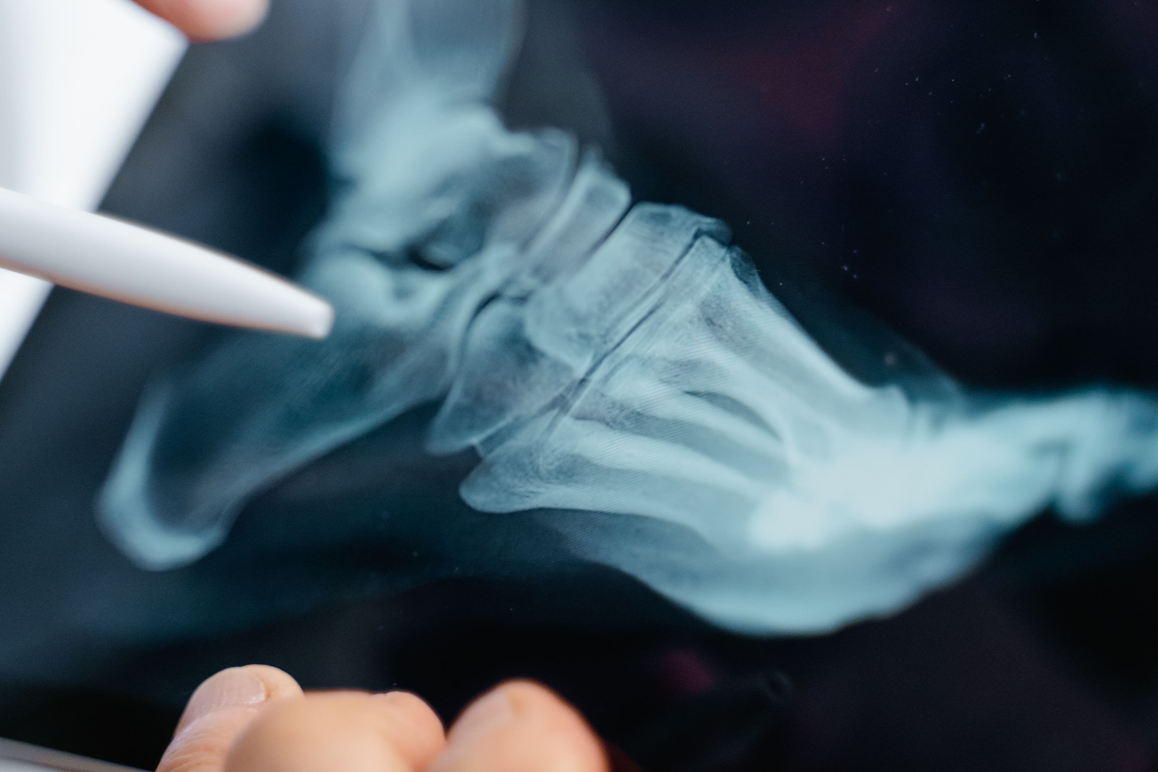 What if your nail problem comes from an underlying bone problem? - Featured image for FALL Clinic Perth podiatry article